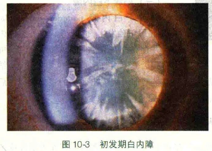 普瑞专家说｜白内障分型之——皮质性白内障